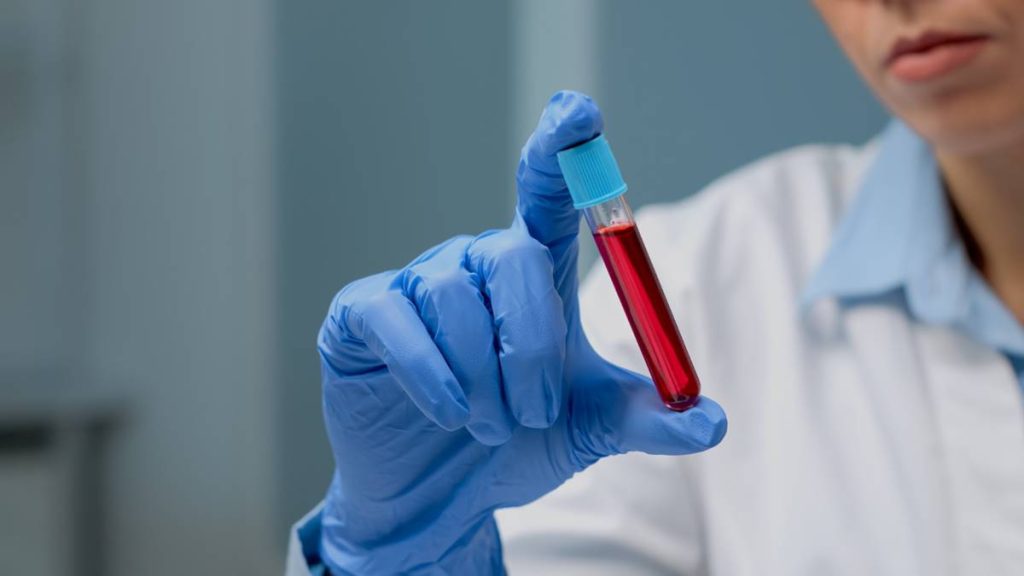 Mi okozhat magas kreatinin szintet? – A vese állapotának fontos jelzője