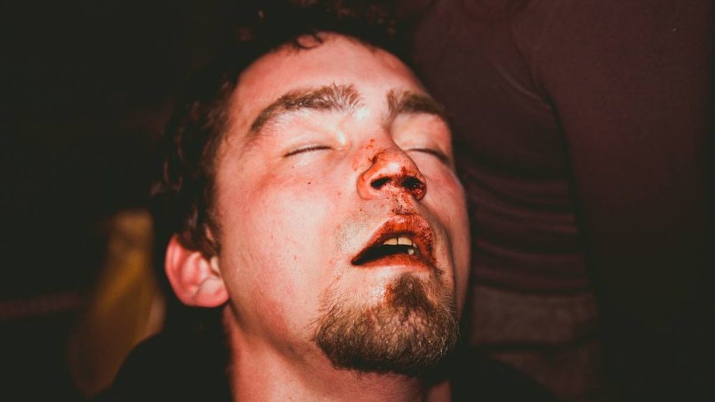 Az orrvérzés hátterében: apró kellemetlenség vagy komoly gond?